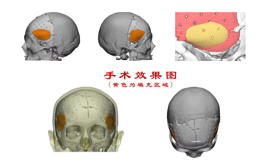 郑大一附院3D打印助力整形外科颞部严重凹陷完美填充