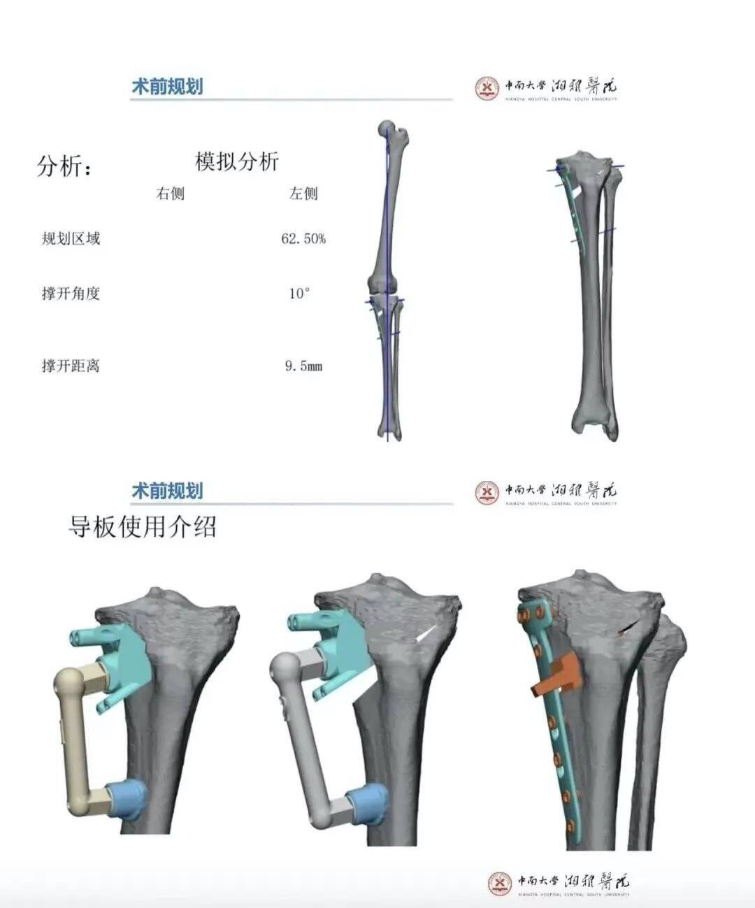 3D打印个性化截骨导向器在PSI术中应用
