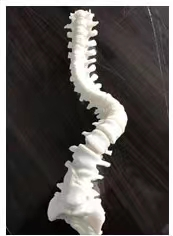 骨科-3D打印脊柱侧弯