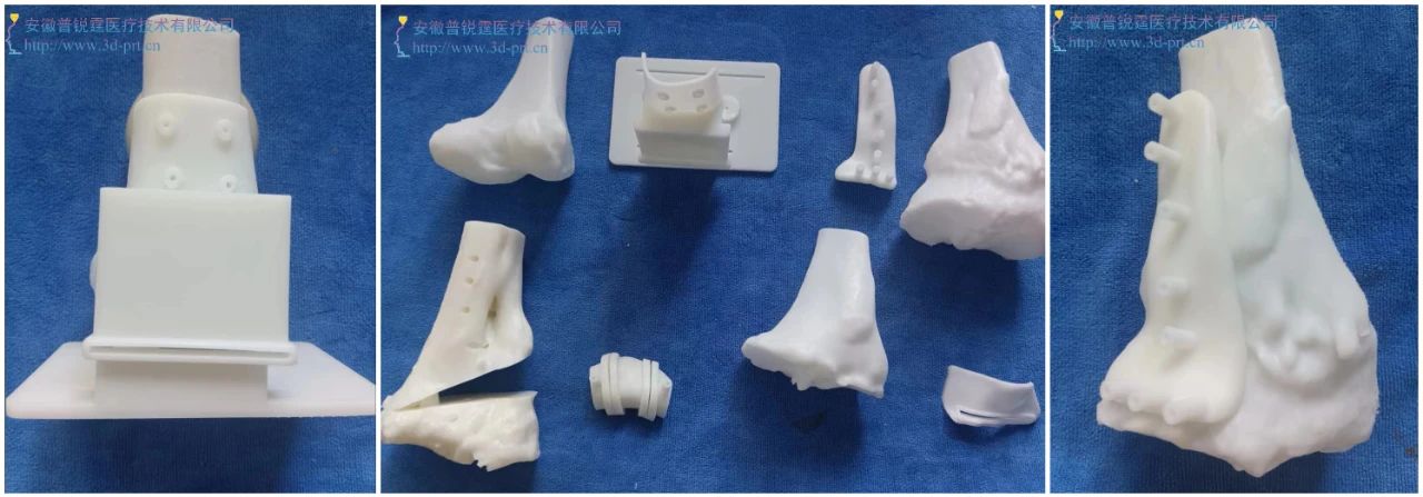 全膝关节置换的新革命：个性化3D打印手术导板的神奇力量！