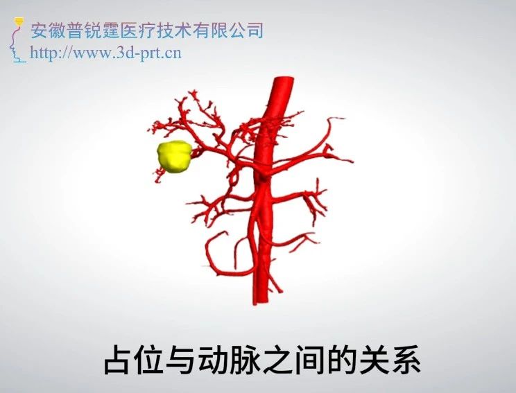 三维可视化技术应用于肝部肿瘤疾病的精准诊疗