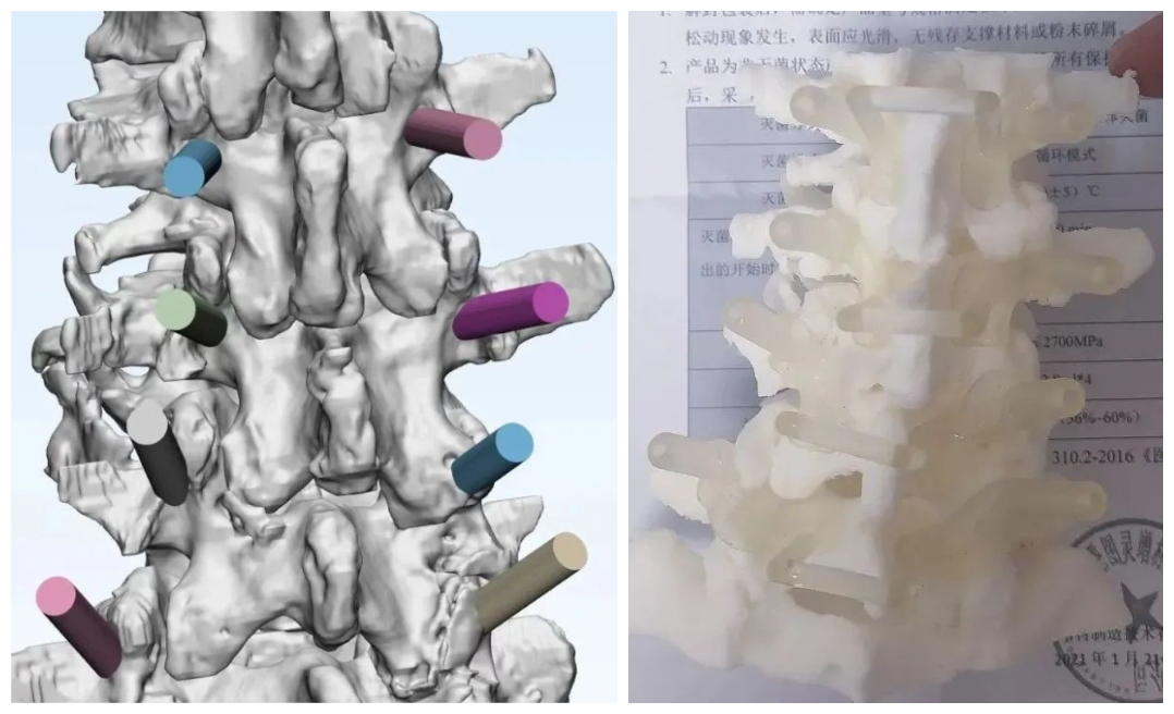 崇州首例！用3D打印技术重塑脊椎